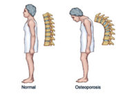 Kādas izmaiņas dzīvesveidā palīdzēs izvairīties no osteoporozes?